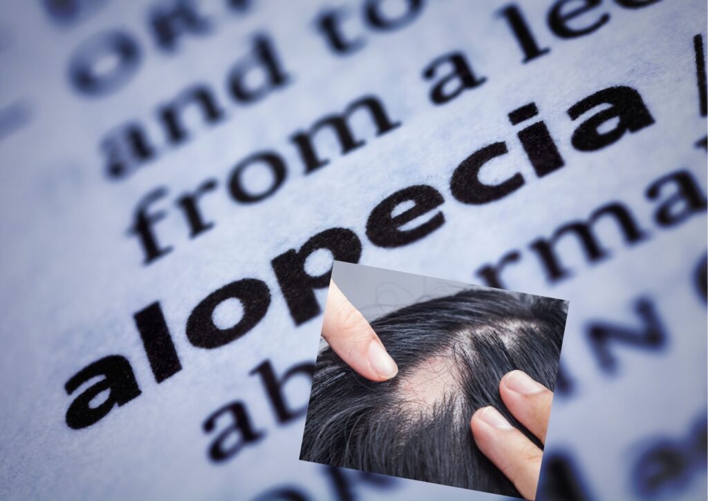 alopecia areata in a relation to gut health and hair loss